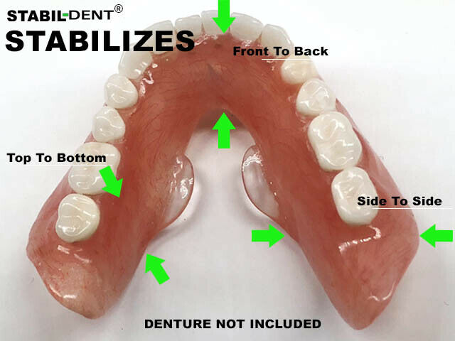 Lower Denture Stabilizers Diy Kit-affordable Denture Stabilization